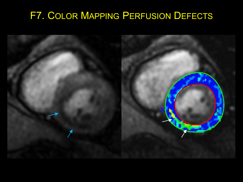 What Is A Mri Cardiac Stress Perfusion Test at Justin Jennings blog